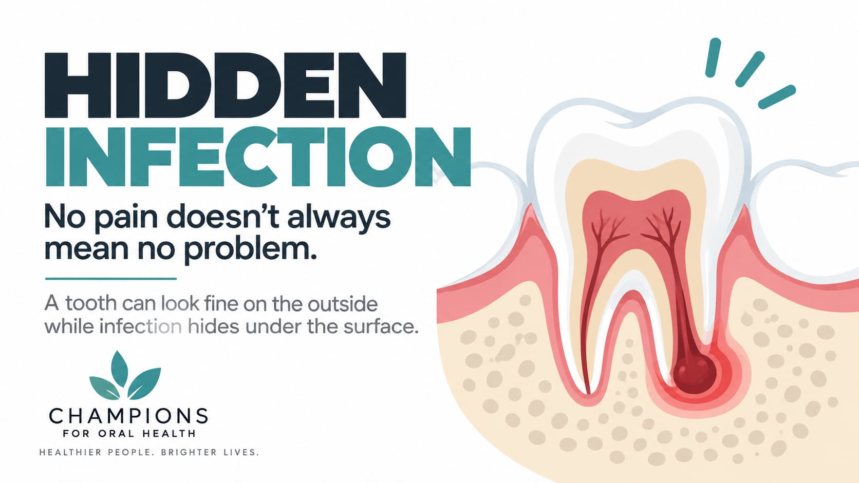 Hidden Dental Infections: Why a Tooth Can Be Infected Without Hurting