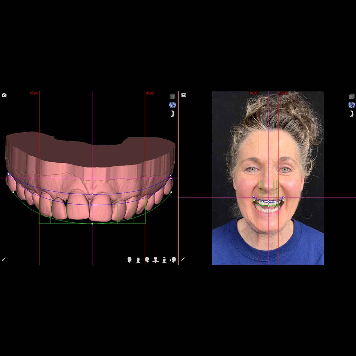 Step 2_ Digital Smile Design Creation