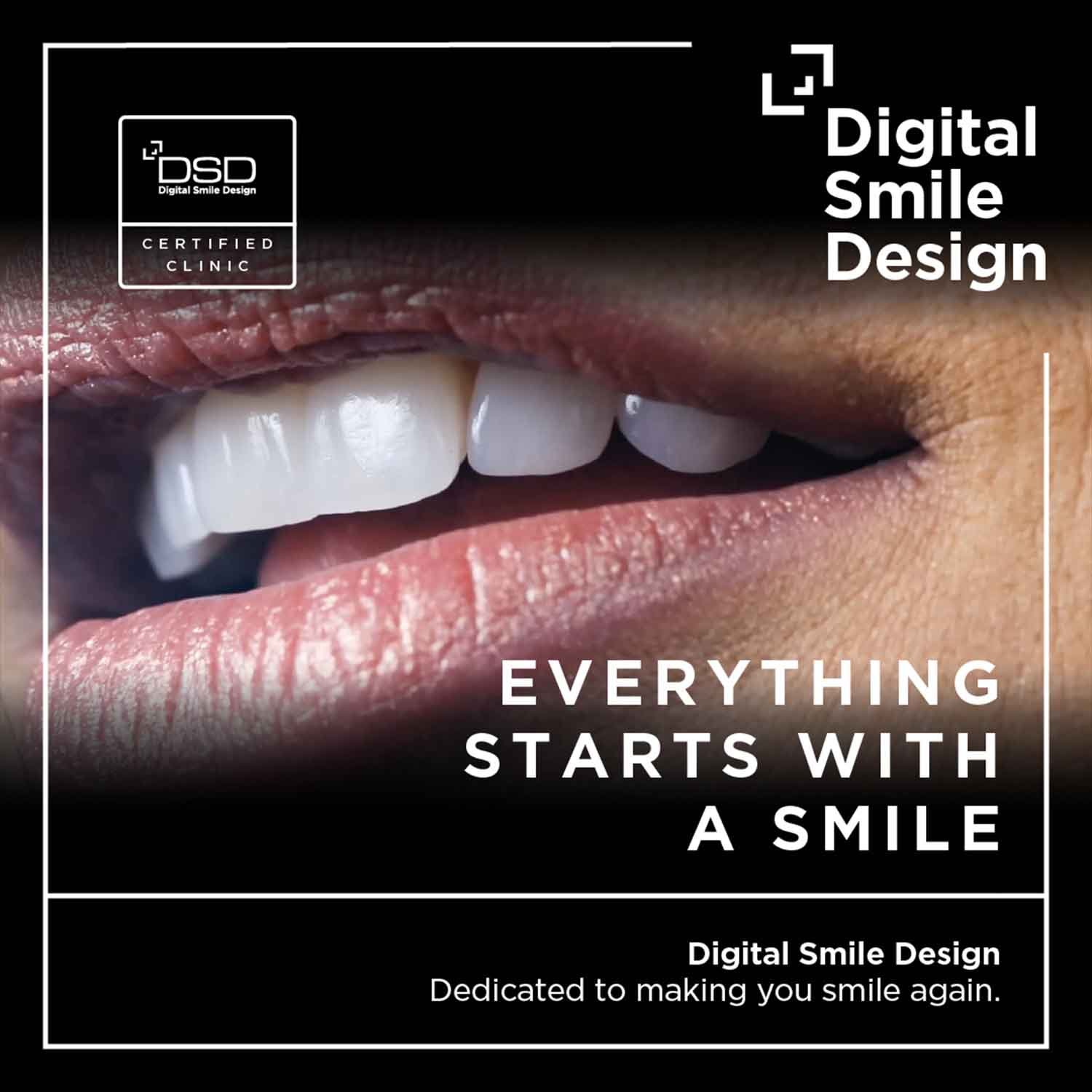 The Digital Smile Design Process at Champions for Oral Health