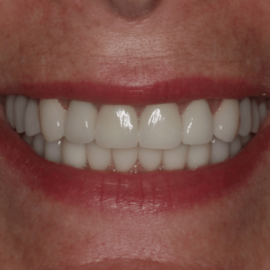 Diane-Solution-Smile-Makeover-3