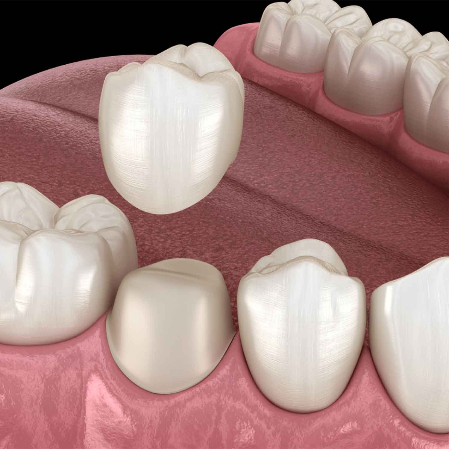 How Dental Crowns Work