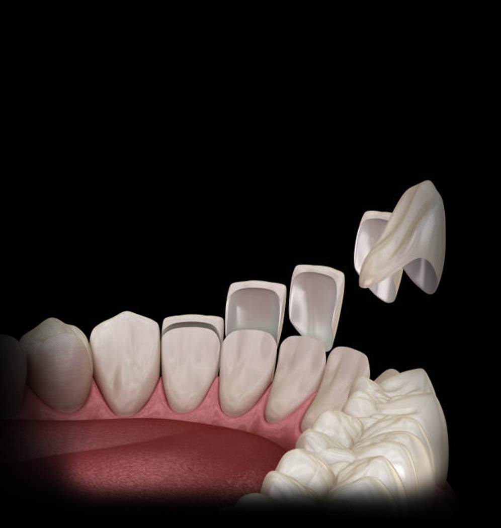Porcelain-Veneers_Hero
