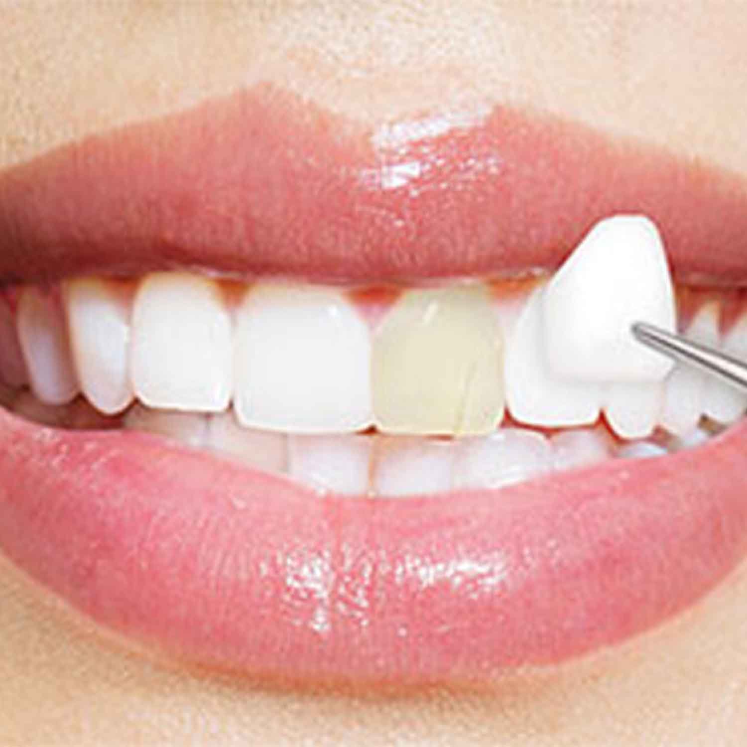 The Champions for Oral Health Veneer Difference
