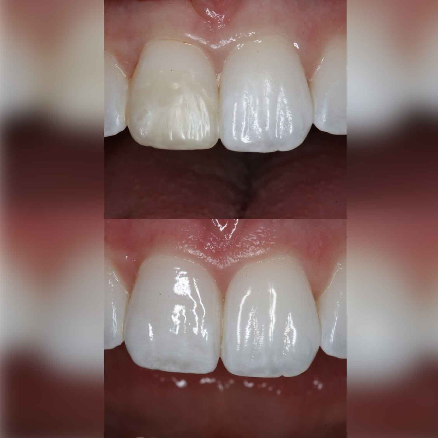 What can Veneers Fix__