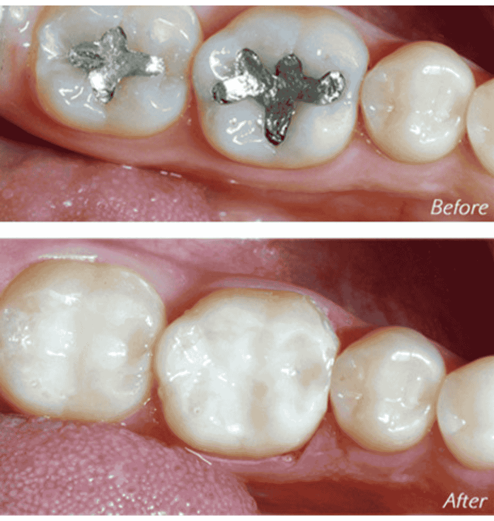 Safe-Mercury-Amalgam-Removal-Technique-Before-After