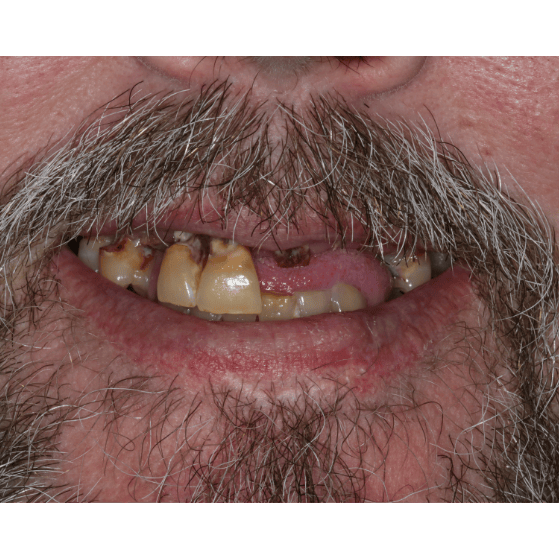 Same-Day-Teeth-Real-Problem