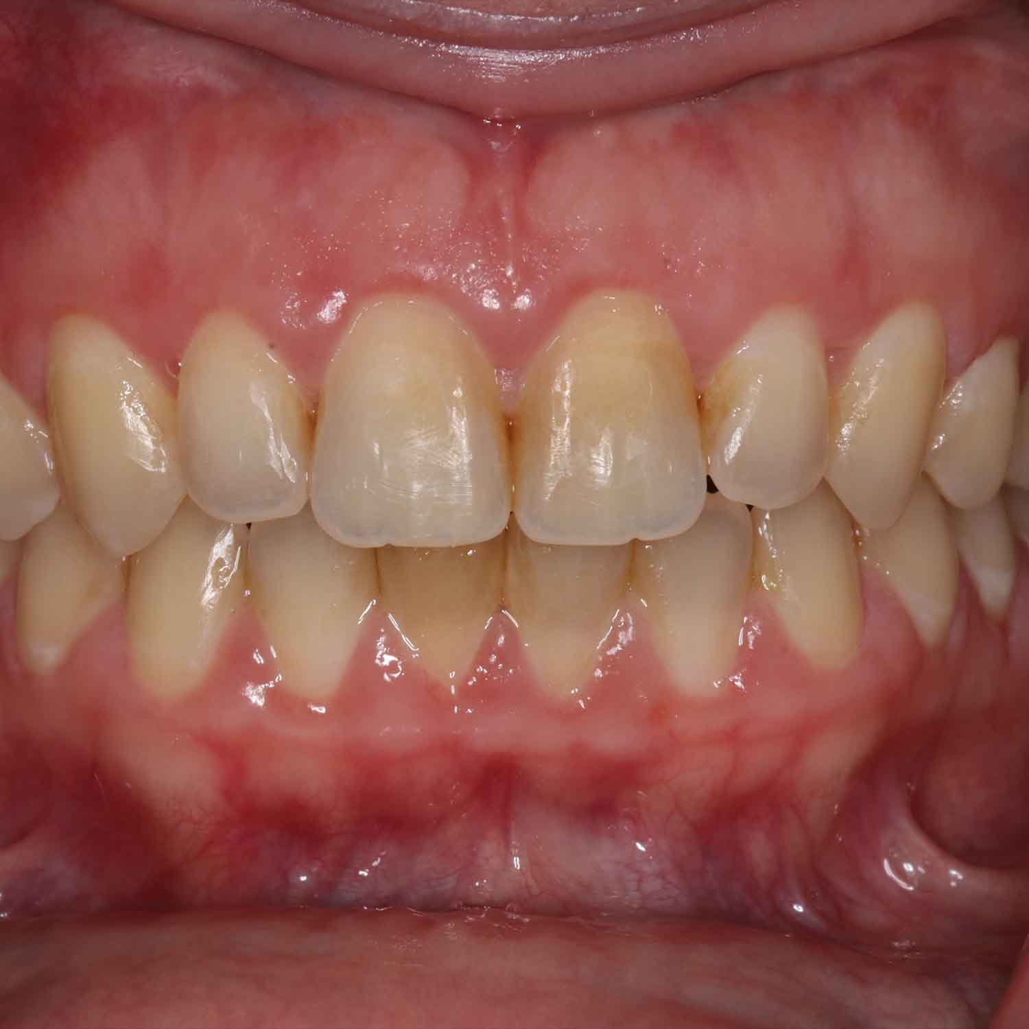 Is Teeth Whitening Right for You_