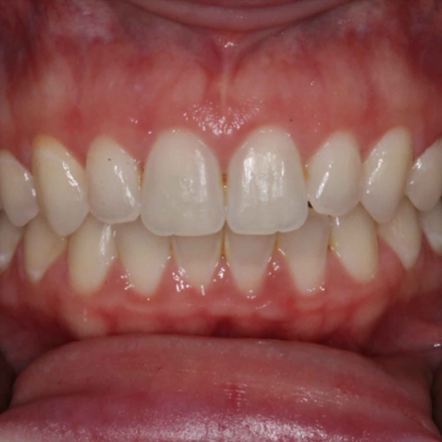 Why Choose Champions for Teeth Whitening