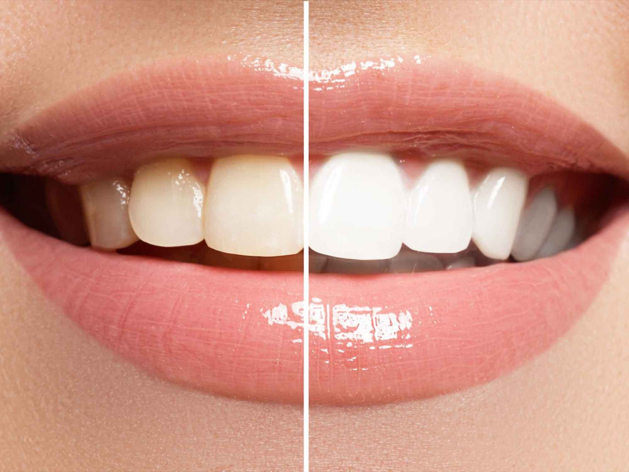 Why Teeth Lose Their Brightness Common Causes of Discoloration