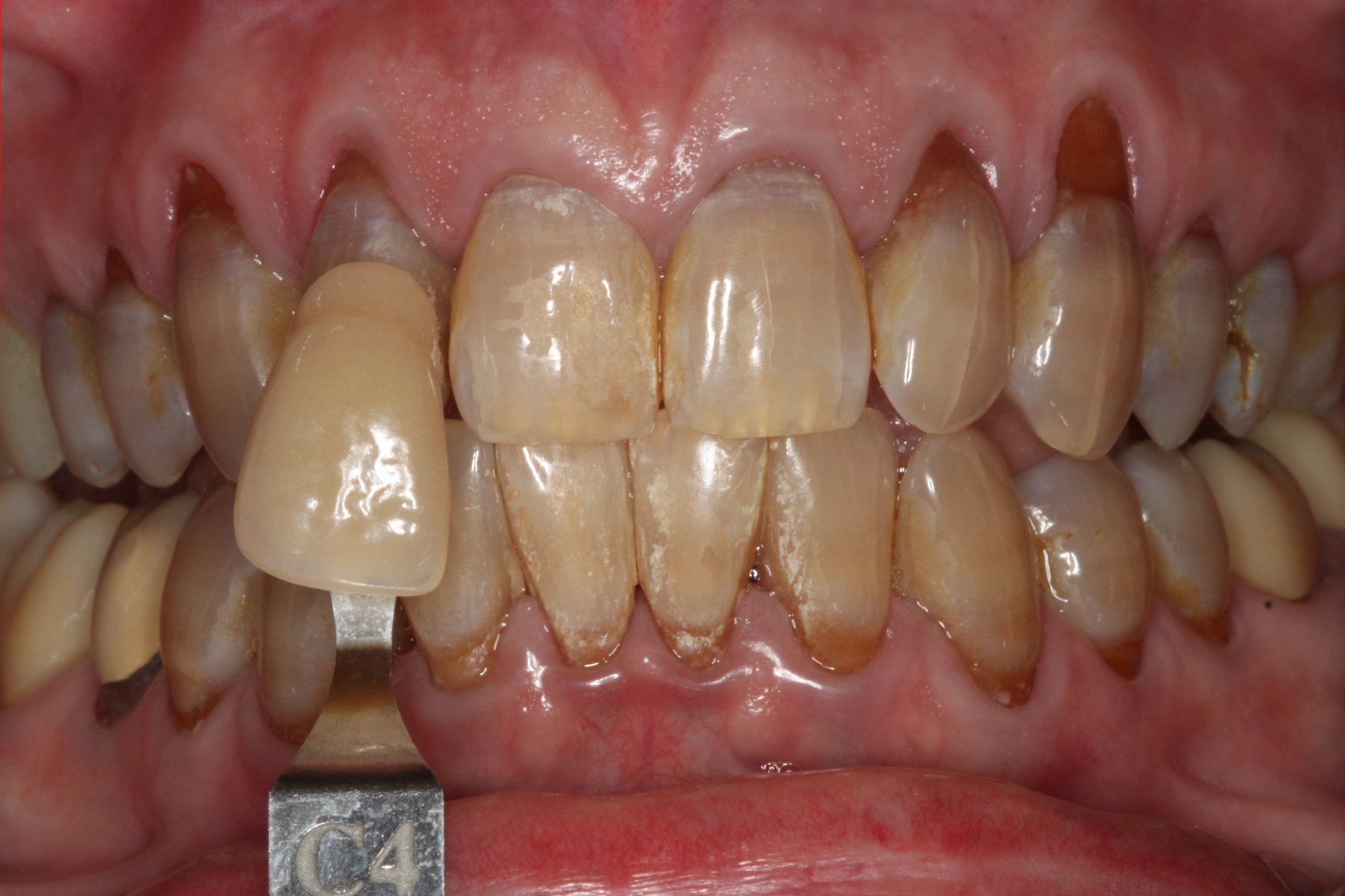 Dental Teeth Whitening Before
