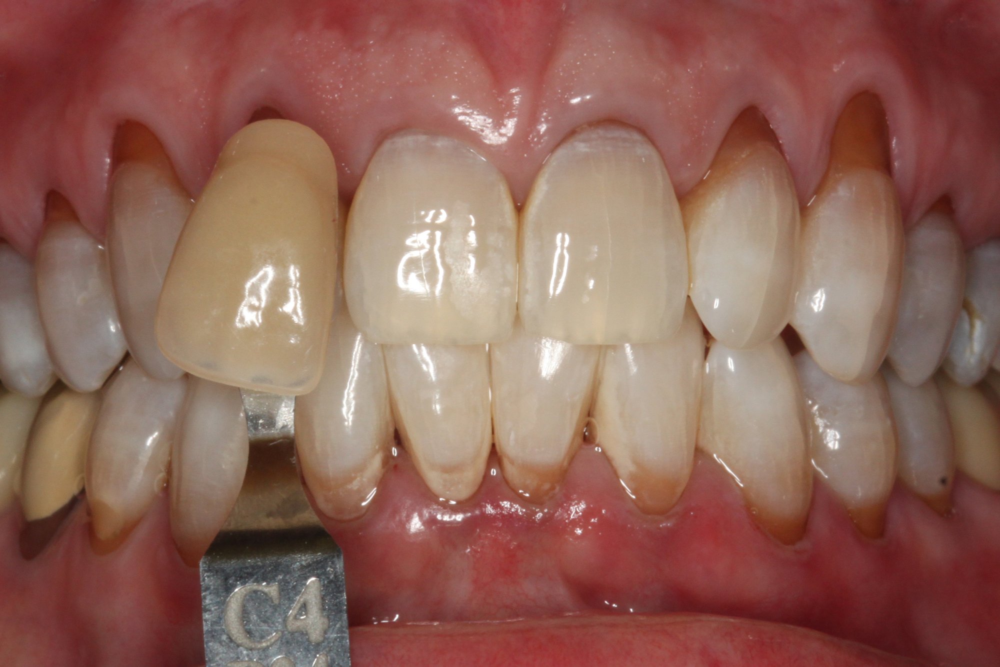 Dental Teeth Whitening After