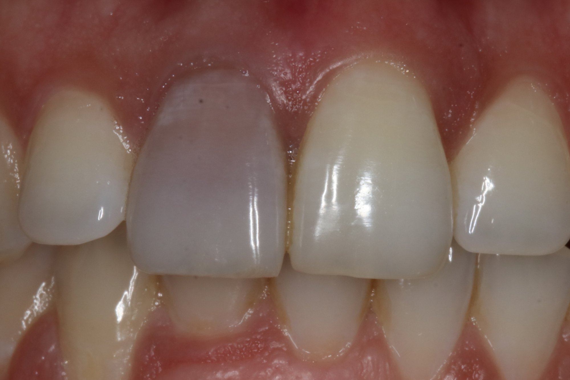 Internal Tooth Whitening