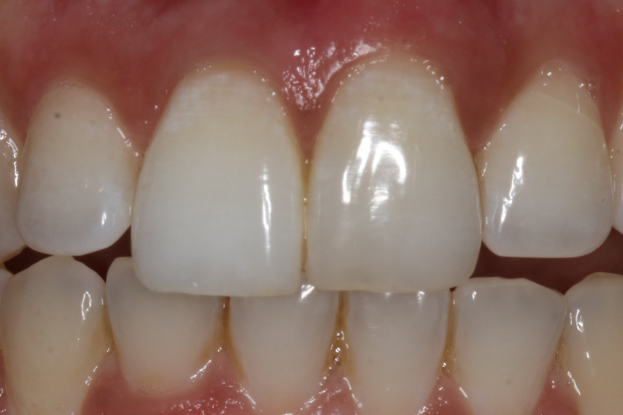Internal Tooth Whitening After