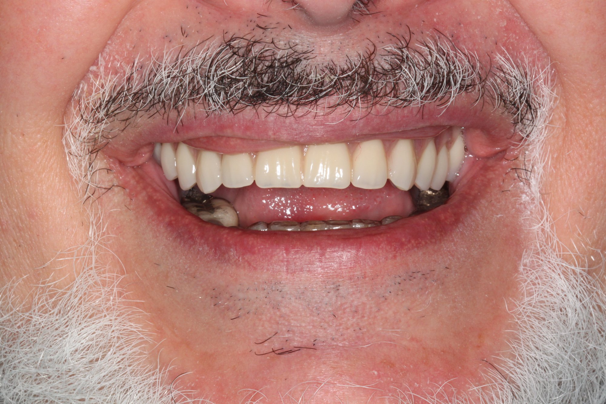 Hybrid Denture