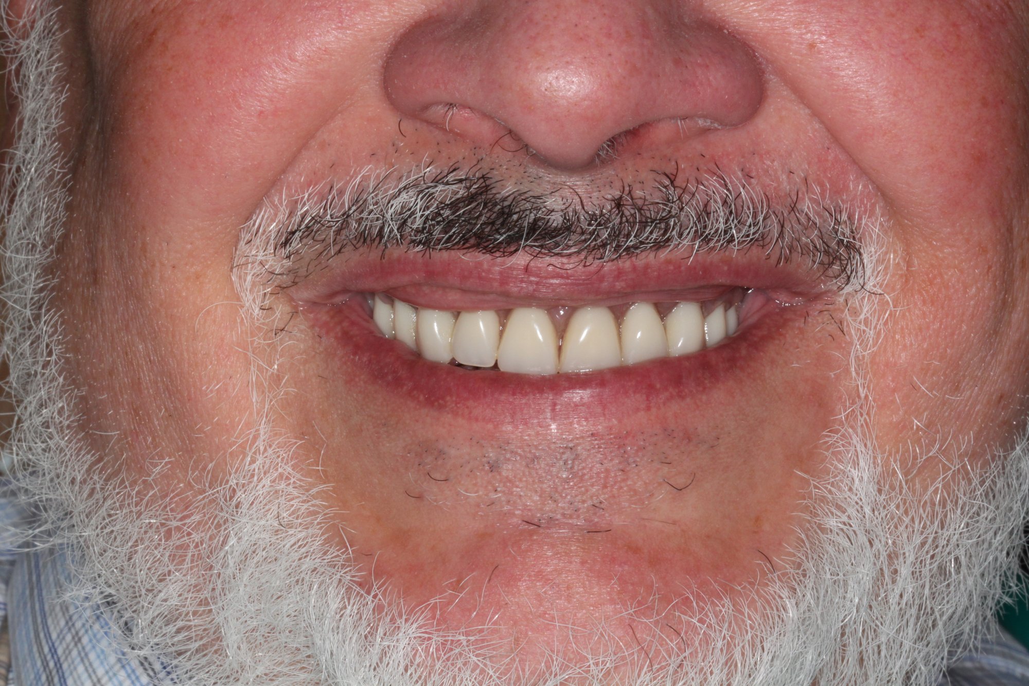 Hybrid Denture Before