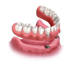 denturestabilization1