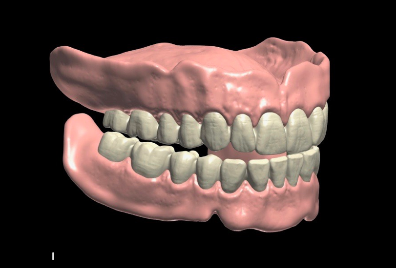 Digital-Dentures
