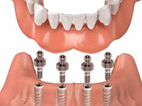 Snap-in-implants1